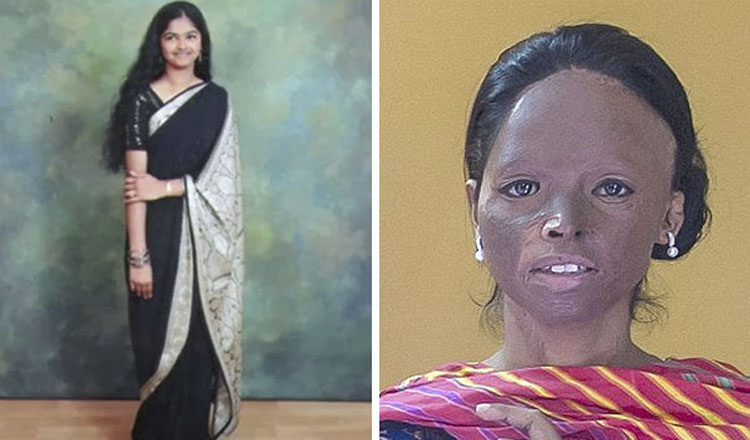 Acid Attack Victim Face Of Fashion Brand 1