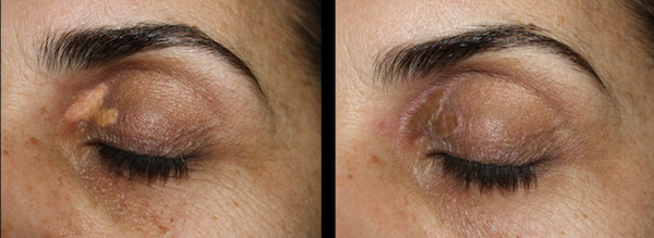 Before and after image of a client who suffered from scarring