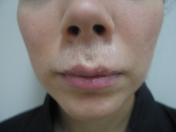 Before image of the client with scarring prior to medical tattoo work