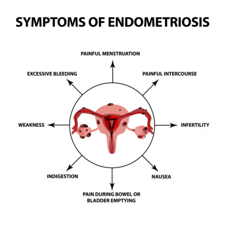 endometriosis